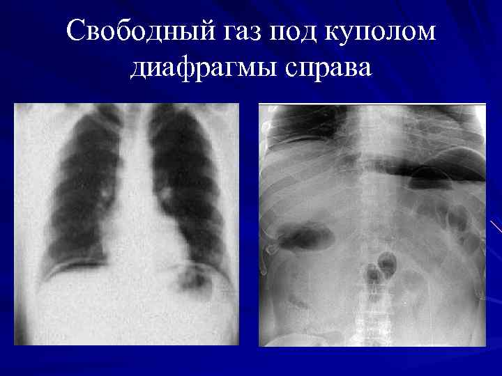 Свободный газ. Свободный ГАЗ под диафрагмой рентген. Свободный ГАЗ под куполом диафрагмы. Свободный ГАЗ под правым куполом диафрагмы. Свободный ГАЗ под куполом диафрагмы рентген.