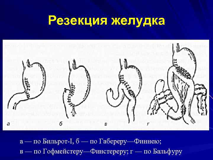 Тип 3 кишечная. Схема резекции желудка по Бильрот 1. Операция по Бильрот 1 и 2.