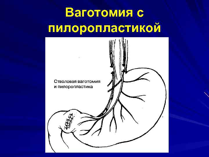 Схема лечения язвенной болезни желудка и двенадцатиперстной