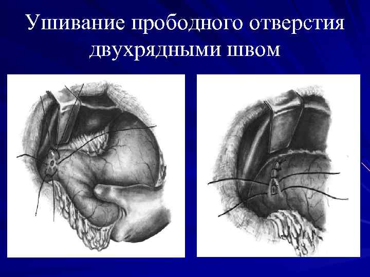 Клиническая картина прободной язвы желудка