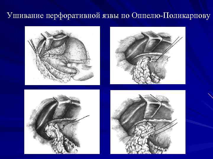 Перфоративная язва желудка карта вызова