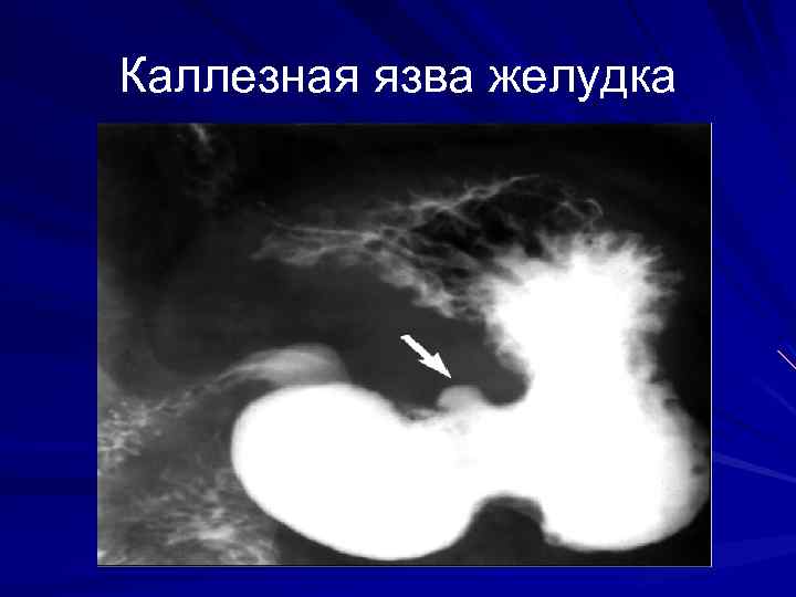 Осложнения желудка 12 перстной кишки. Каллезная пенетрирующая язва ДПК. Каллезная пенетрирующая язва желудка. Пептическая язва желудка рентген. Перфоративная язва желудка эндоскопия.