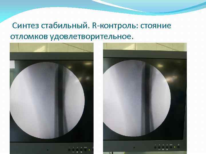  Синтез стабильный. R-контроль: стояние отломков удовлетворительное. 