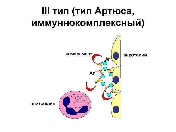 III тип (тип Артюса, иммуннокомплексный) комплемент Аг Ат нейтрофил эндотелий 