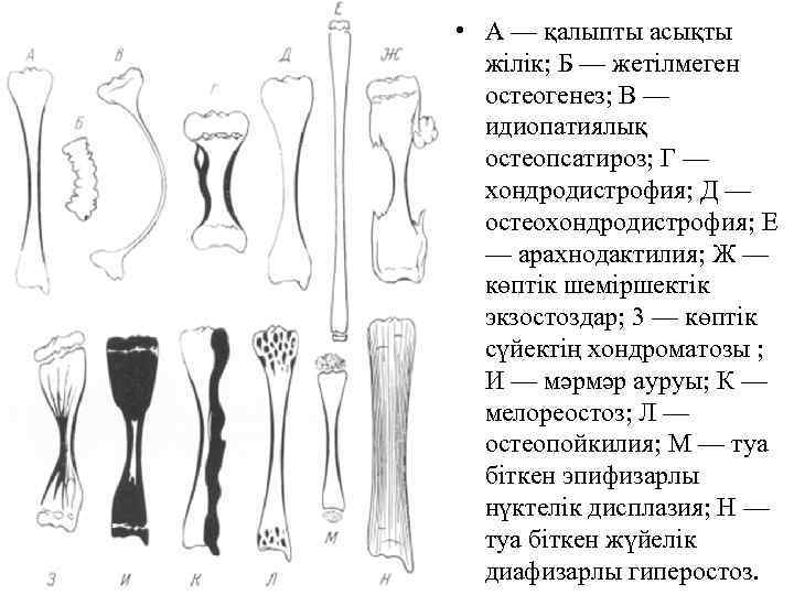 Переломы трубчатых костей. Типы несовершенного остеогенеза. Несовершенный остеогенез 2 типа. Второй Тип несовершенного остеогенеза. Несовершенный остеогенез 4 типа.