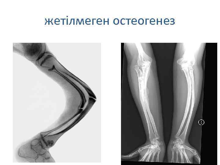 жетілмеген остеогенез 