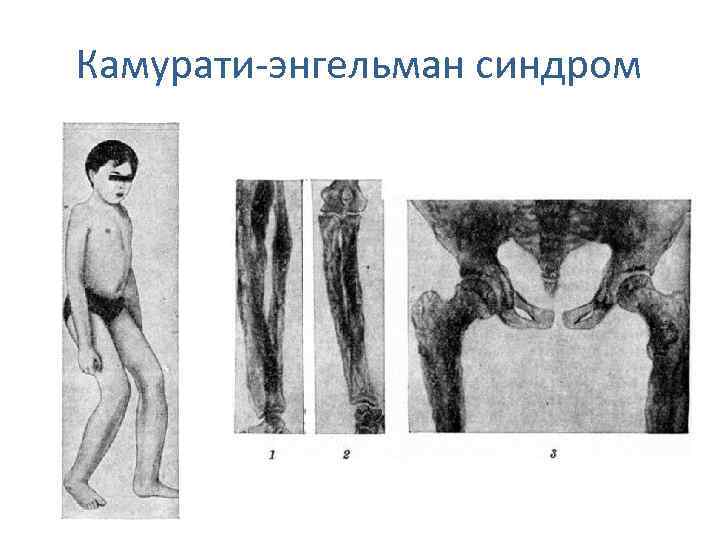 Камурати-энгельман синдром 