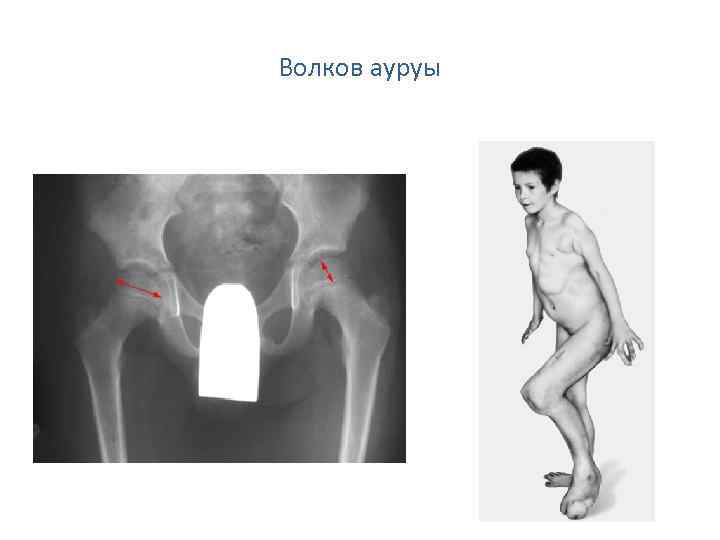 Волков ауруы 