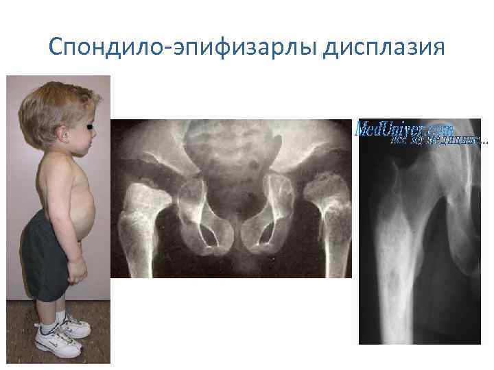 Спондило-эпифизарлы дисплазия 