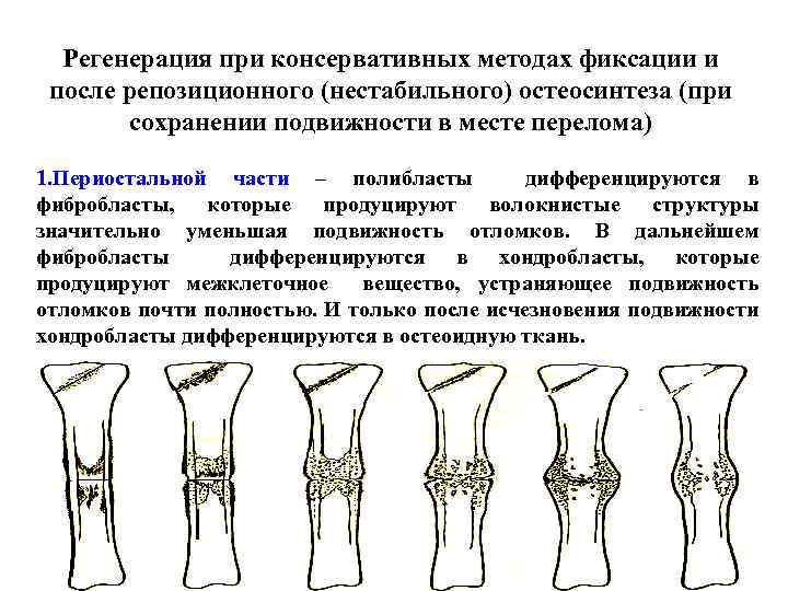 Регенерация при консервативных методах фиксации и после репозиционного (нестабильного) остеосинтеза (при сохранении подвижности в