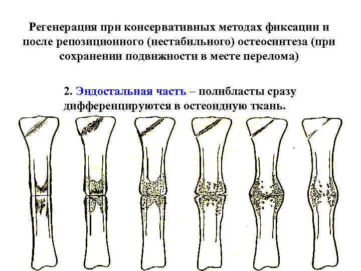 Регенерация при консервативных методах фиксации и после репозиционного (нестабильного) остеосинтеза (при сохранении подвижности в