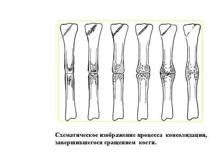 Схематическое изображение процесса консолидации, завершившегося сращением кости. 