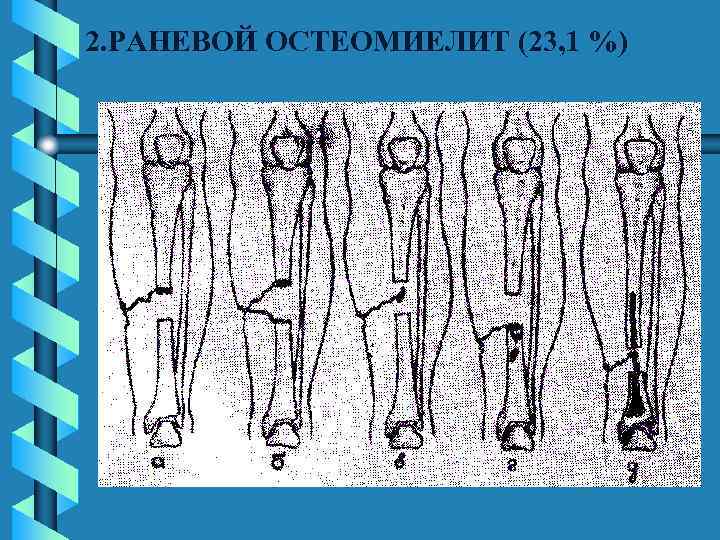 2. РАНЕВОЙ ОСТЕОМИЕЛИТ (23, 1 %) 