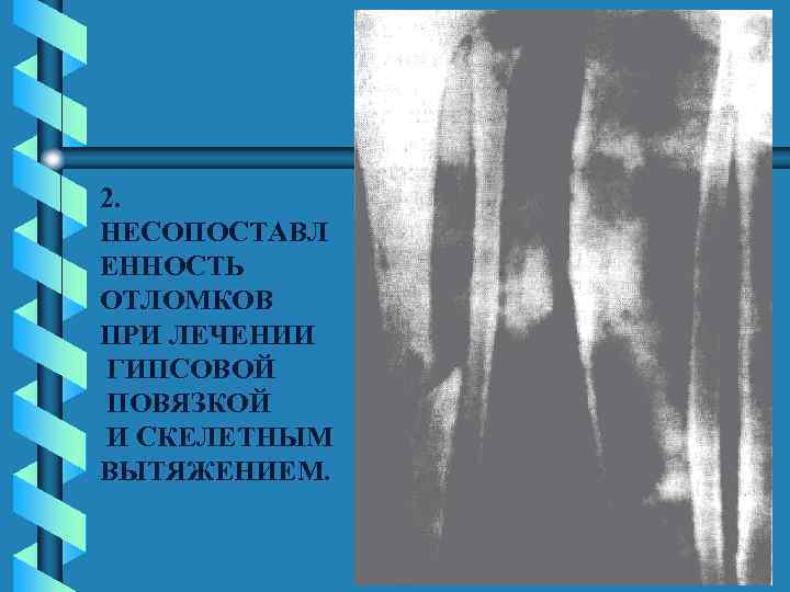 2. НЕСОПОСТАВЛ ЕННОСТЬ ОТЛОМКОВ ПРИ ЛЕЧЕНИИ ГИПСОВОЙ ПОВЯЗКОЙ И СКЕЛЕТНЫМ ВЫТЯЖЕНИЕМ. 