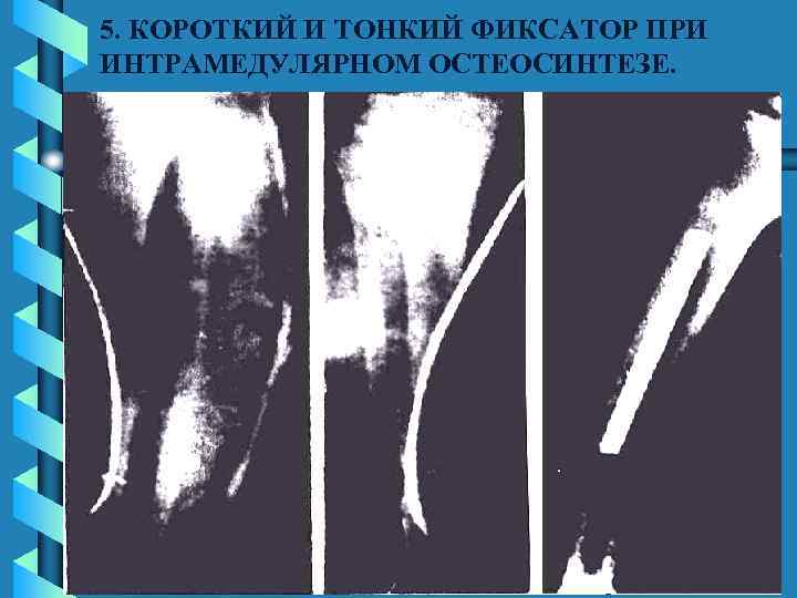 5. КОРОТКИЙ И ТОНКИЙ ФИКСАТОР ПРИ ИНТРАМЕДУЛЯРНОМ ОСТЕОСИНТЕЗЕ. 