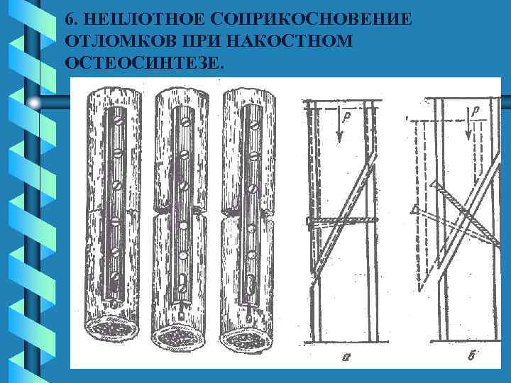 6. НЕПЛОТНОЕ СОПРИКОСНОВЕНИЕ ОТЛОМКОВ ПРИ НАКОСТНОМ ОСТЕОСИНТЕЗЕ. 