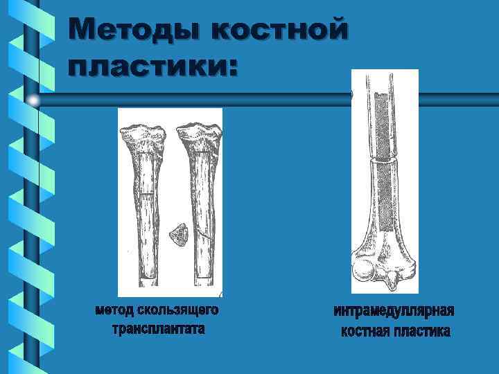 Методы костной пластики: 