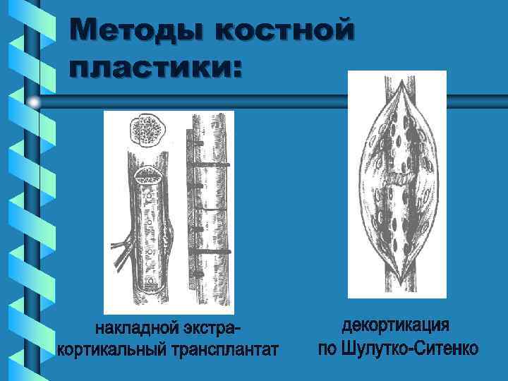 Методы костной пластики: 