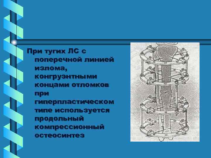 При тугих ЛС с поперечной линией излома, конгруэнтными концами отломков при гиперпластическом типе используется