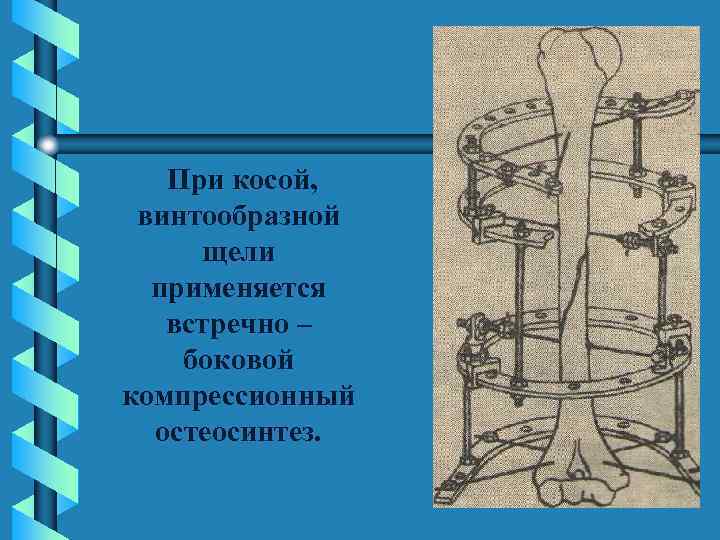 При косой, винтообразной щели применяется встречно – боковой компрессионный остеосинтез. 