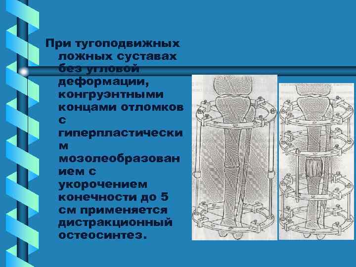 При тугоподвижных ложных суставах без угловой деформации, конгруэнтными концами отломков с гиперпластически м мозолеобразован