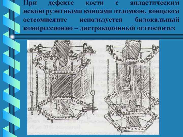 При дефекте кости с апластическим неконгруэнтными концами отломков, концевом остеомиелите используется билокальный компрессионно –