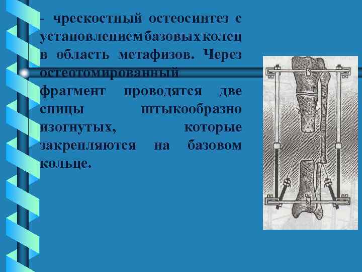  чрескостный остеосинтез с установлением базовых колец в область метафизов. Через остеотомированный фрагмент проводятся