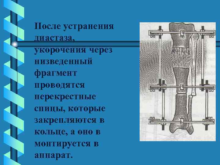 После устранения диастаза, укорочения через низведенный фрагмент проводятся перекрестные спицы, которые закрепляются в кольце,