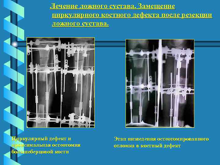 Лечение ложного сустава. Замещение циркулярного костного дефекта после резекции ложного сустава. Циркулярный дефект и