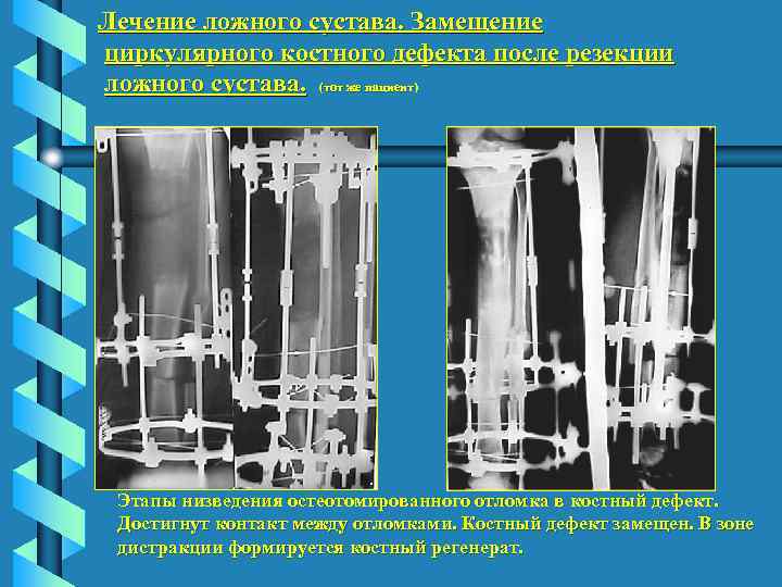 Лечение ложного сустава. Замещение циркулярного костного дефекта после резекции ложного сустава. (тот же пациент)