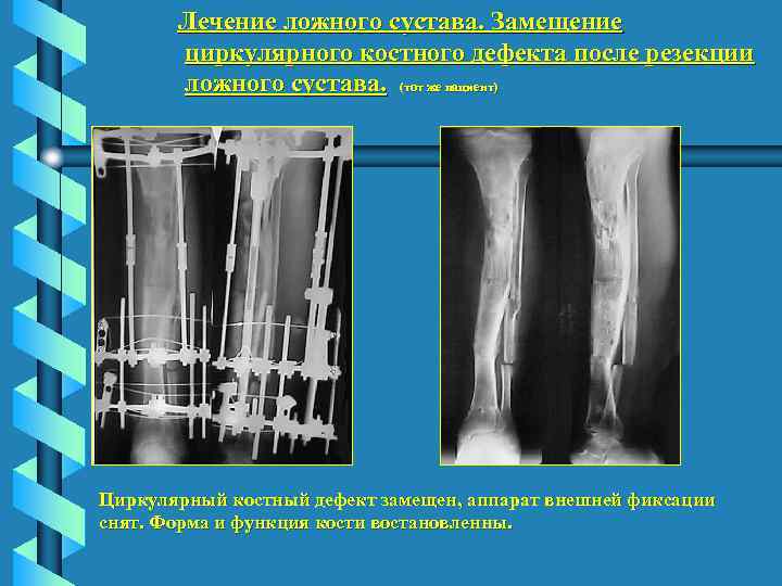 Лечение ложного сустава. Замещение циркулярного костного дефекта после резекции ложного сустава. (тот же пациент)