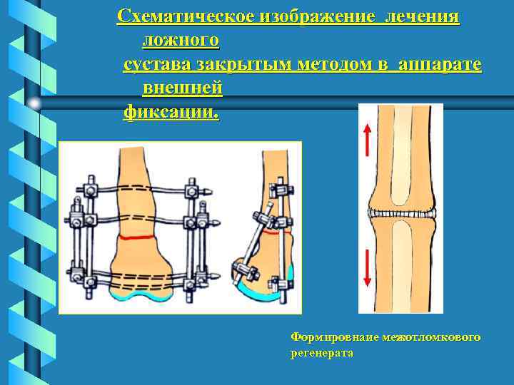 Схематическое изображение лечения ложного сустава закрытым методом в аппарате внешней фиксации. Формировнаие межотломкового регенерата