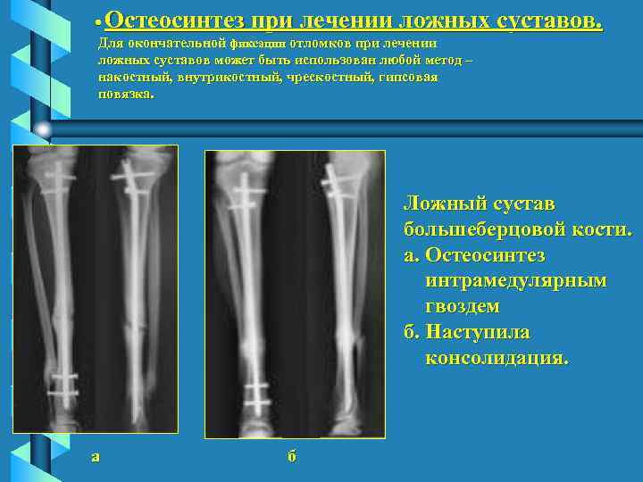  Остеосинтез при лечении ложных суставов. Для окончательной фиксации отломков при лечении ложных суставов