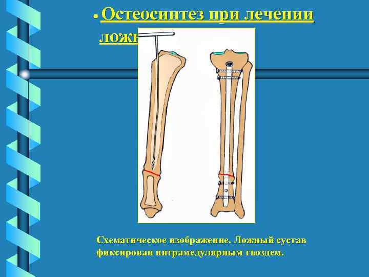  Остеосинтез при лечении ложных суставов. Схематическое изображение. Ложный сустав фиксирован интрамедулярным гвоздем. 