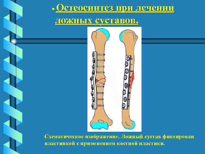  Остеосинтез при лечении ложных суставов. Схематическое изображение. Ложный сустав фиксирован пластинкой с применением