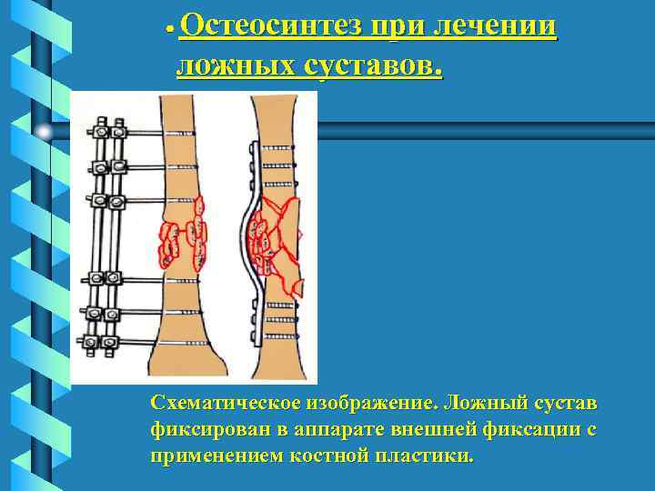  Остеосинтез при лечении ложных суставов. Схематическое изображение. Ложный сустав фиксирован в аппарате внешней