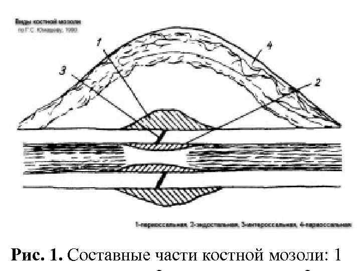 Рис. 1. Составные части костной мозоли: 1 