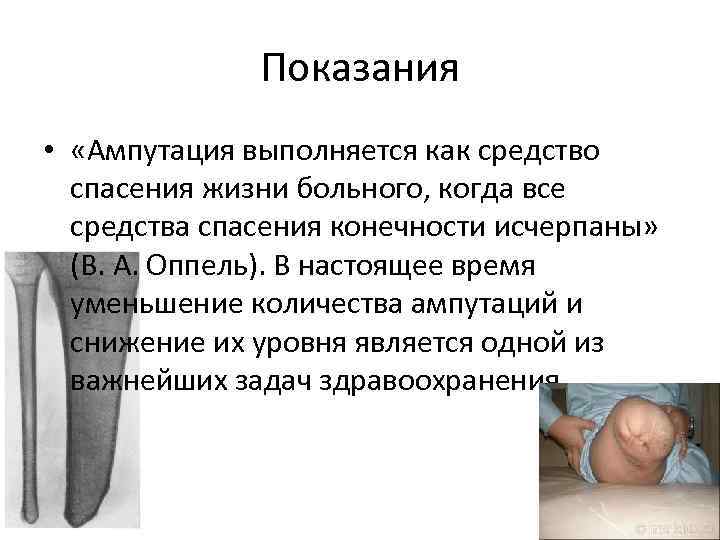 Показания • «Ампутация выполняется как средство спасения жизни больного, когда все средства спасения конечности
