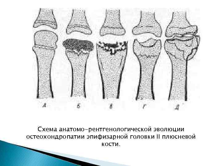 Схема анатомо-рентгенологической эволюции остеохондропатии эпифизарной головки II плюсневой кости. 