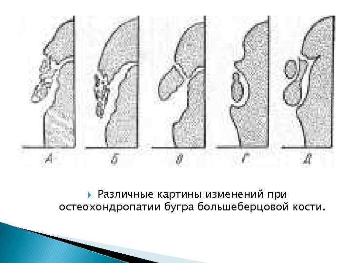 Различные картины изменений при остеохондропатии бугра большеберцовой кости. 