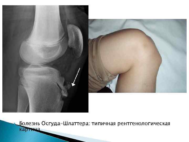  Болезнь Осгуда-Шлаттера: типичная рентгенологическая картина 