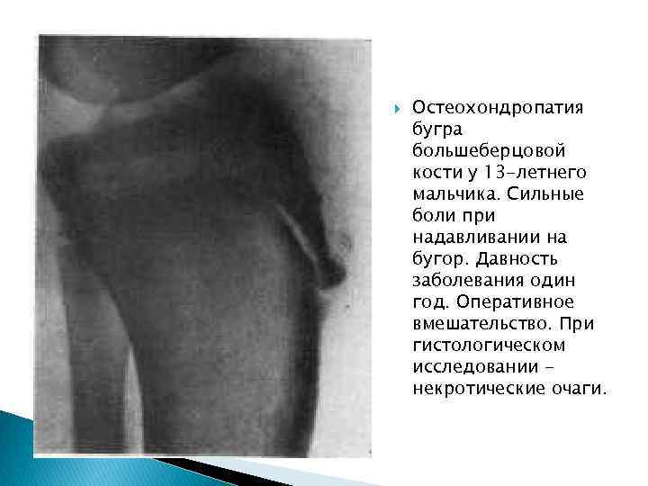  Остеохондропатия бугра большеберцовой кости у 13 -летнего мальчика. Сильные боли при надавливании на