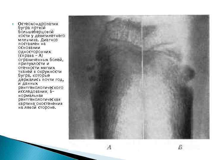  Остеохондропатия бугра пртвой большеберцовой кости у девятилетнего мпльчика. Диагноз поставлен на основании односторонних