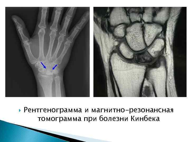 Болезнь кинбека презентация