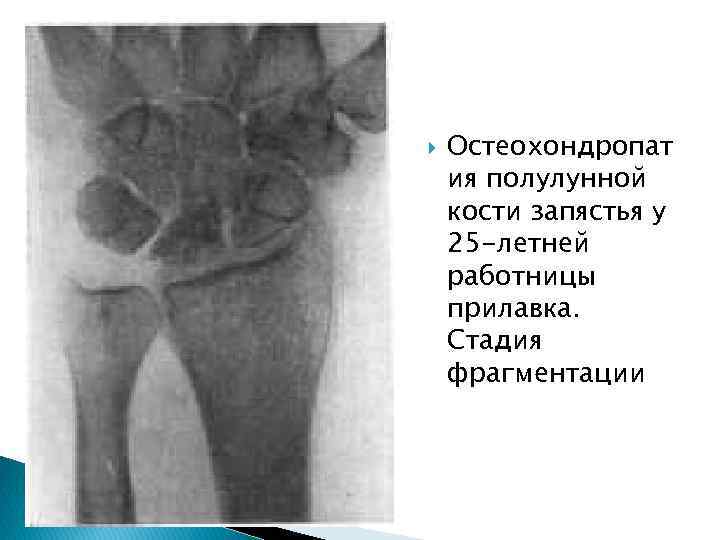  Остеохондропат ия полулунной кости запястья у 25 -летней работницы прилавка. Стадия фрагментации 
