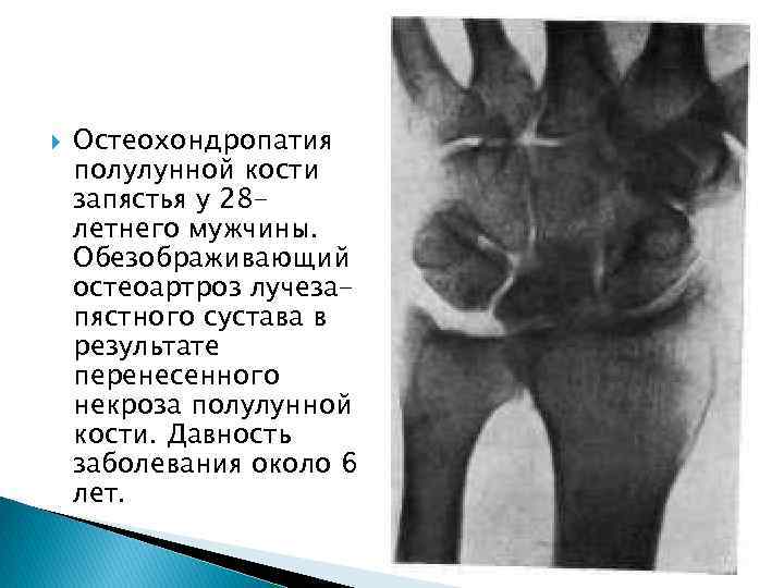  Остеохондропатия полулунной кости запястья у 28 летнего мужчины. Обезображивающий остеоартроз лучезапястного сустава в
