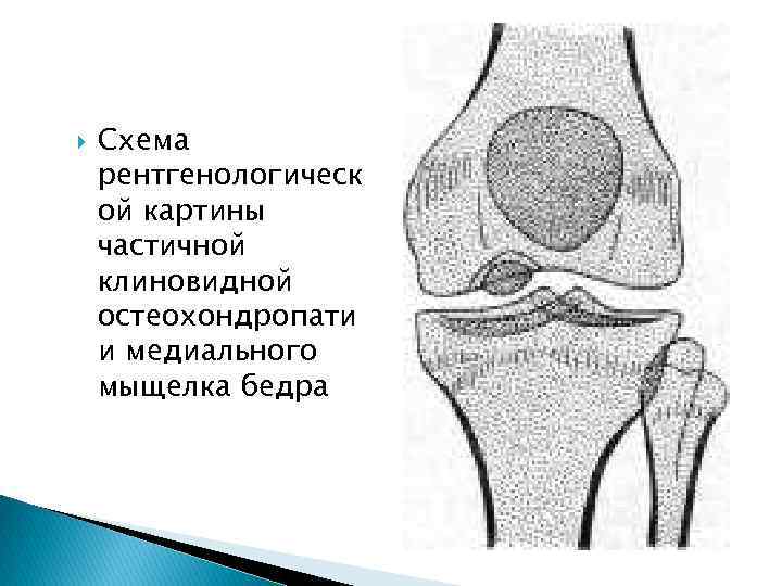  Схема рентгенологическ ой картины частичной клиновидной остеохондропати и медиального мыщелка бедра 