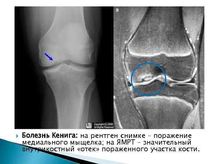 Субхондральный перелом мыщелка