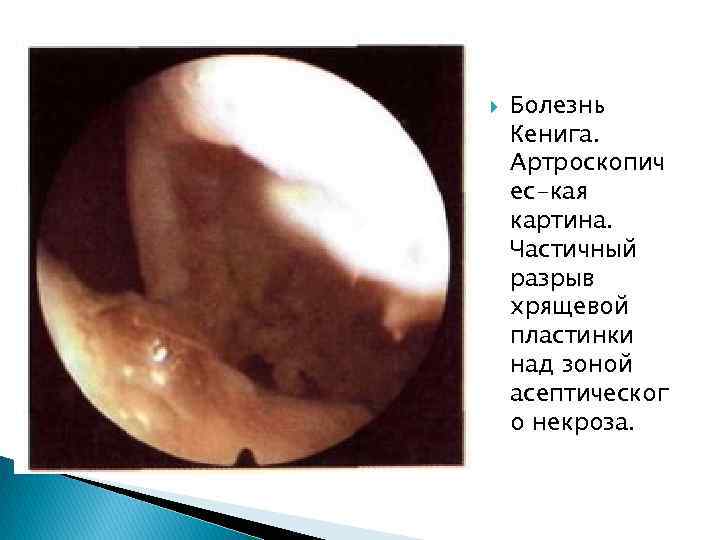  Болезнь Кенига. Артроскопич ес-кая картина. Частичный разрыв хрящевой пластинки над зоной асептическог о