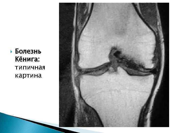  Болезнь Кёнига: типичная картина 